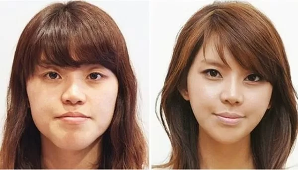 عمليات التجميل في كوريا